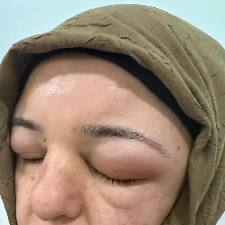 Saç Boyası Sonrası Ciddi Alerjik Reaksiyon Yaşadık