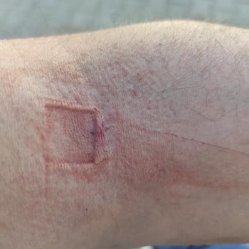 Türk Kızılay Kan Bağışı Sonrası Dikkatsiz Uygulama Nedeniyle Yaşanan Mağduriyet!