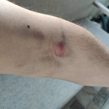 Türk Kızılay Kan Bağışı Sonrası Dikkatsiz Uygulama Nedeniyle Yaşanan Mağduriyet!