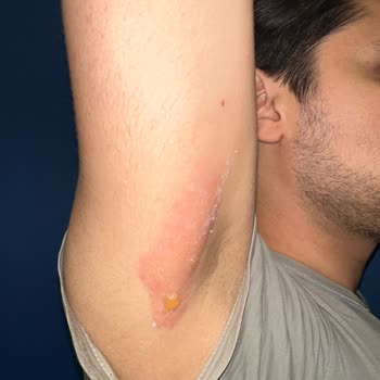 Stanley Termos Kapağı Sorunu Ve Ciddi Yanıkla Sonuçlanan Mağduriyet