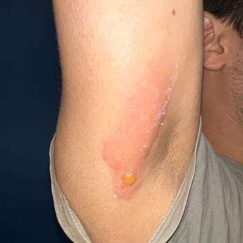 Stanley Termos Kapağı Sorunu Ve Ciddi Yanıkla Sonuçlanan Mağduriyet