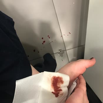 Mağazada Çivili Alarm Parçası Nedeniyle Yaralandım, Yardım Alamadım