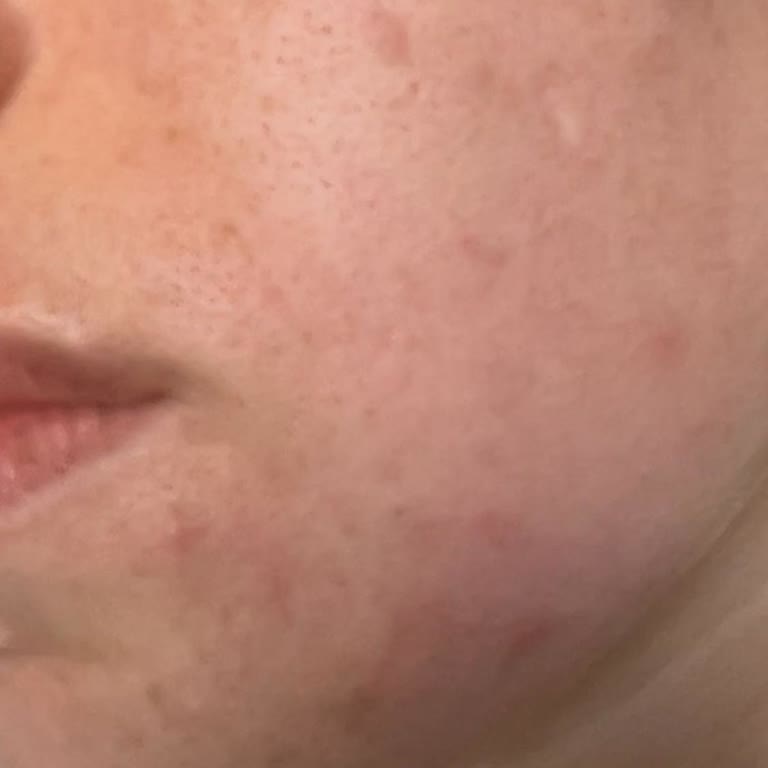 L'Oreal Paris Renkli Güneş Kremi Yüzümde Alerjik Reaksiyona Sebep Oldu