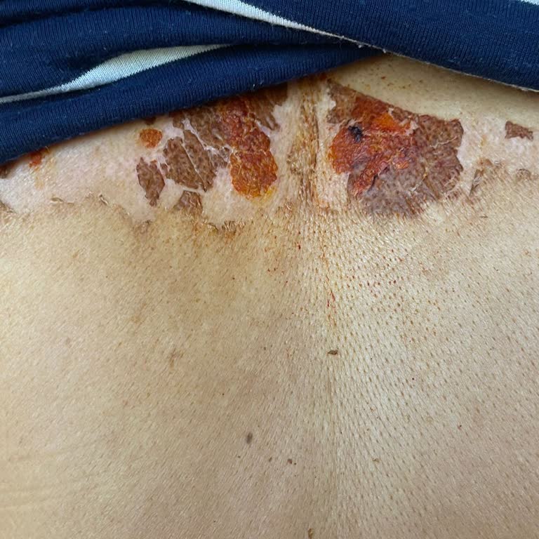 Ameliyat Sonrası Ciddi Yanıklar Ve İlgisizlik