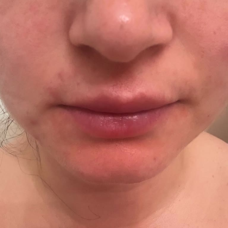 İpek Parsak Estetik Ve Güzellik Merkezi Dolgu Hüsranı!