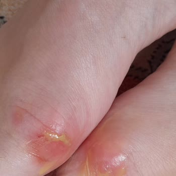 FLO'dan Aldığım Terlik Ayağımı Yaraladı, Yardım Bekliyorum