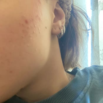 Cilt Ürünleri Sonrası Yüzümdeki Sorunlar Ve Tedavi Sürecim