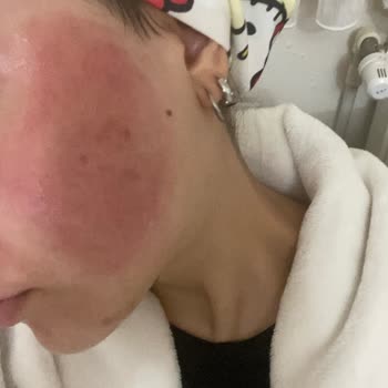 Cilt Ürünleri Sonrası Yüzümdeki Sorunlar Ve Tedavi Sürecim