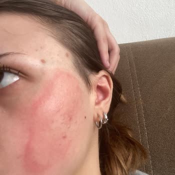 Cilt Ürünleri Sonrası Yüzümdeki Sorunlar Ve Tedavi Sürecim