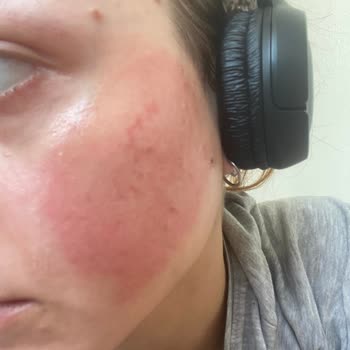 Cilt Ürünleri Sonrası Yüzümdeki Sorunlar Ve Tedavi Sürecim