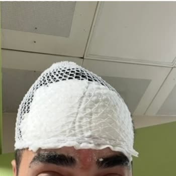 Yüz Bölgesi İşleminde Ciddi İhmal Ve Yanık Şikayeti