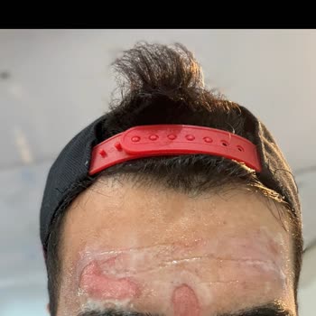 Yüz Bölgesi İşleminde Ciddi İhmal Ve Yanık Şikayeti