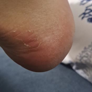 Tek Giyişte Ayaklarıma Zarar Veren Ayakkabı İçin Değişim Talebi