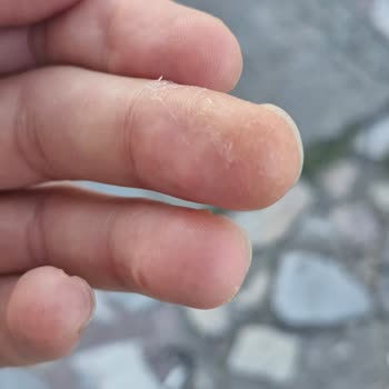 Gratis Kozmetik Serum Kullanımı Sonrası Parmakta Cilt Sorunu!