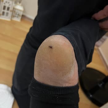 Ayakkabı İçindeki Çivi Nedeniyle Topuk Yaralanması