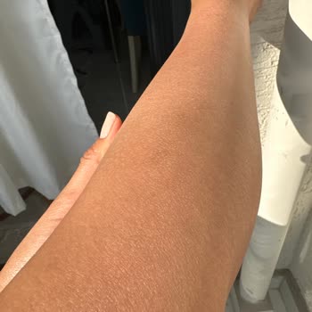 Bronzlaştırıcı Cildimde Yanıklara Ve Kalıcı İzlere Sebep Oldu