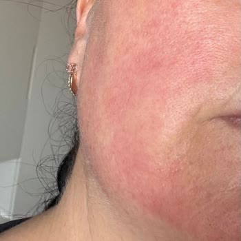 Loreal Güneş Kremi Yüzümde Alerji Yaptı