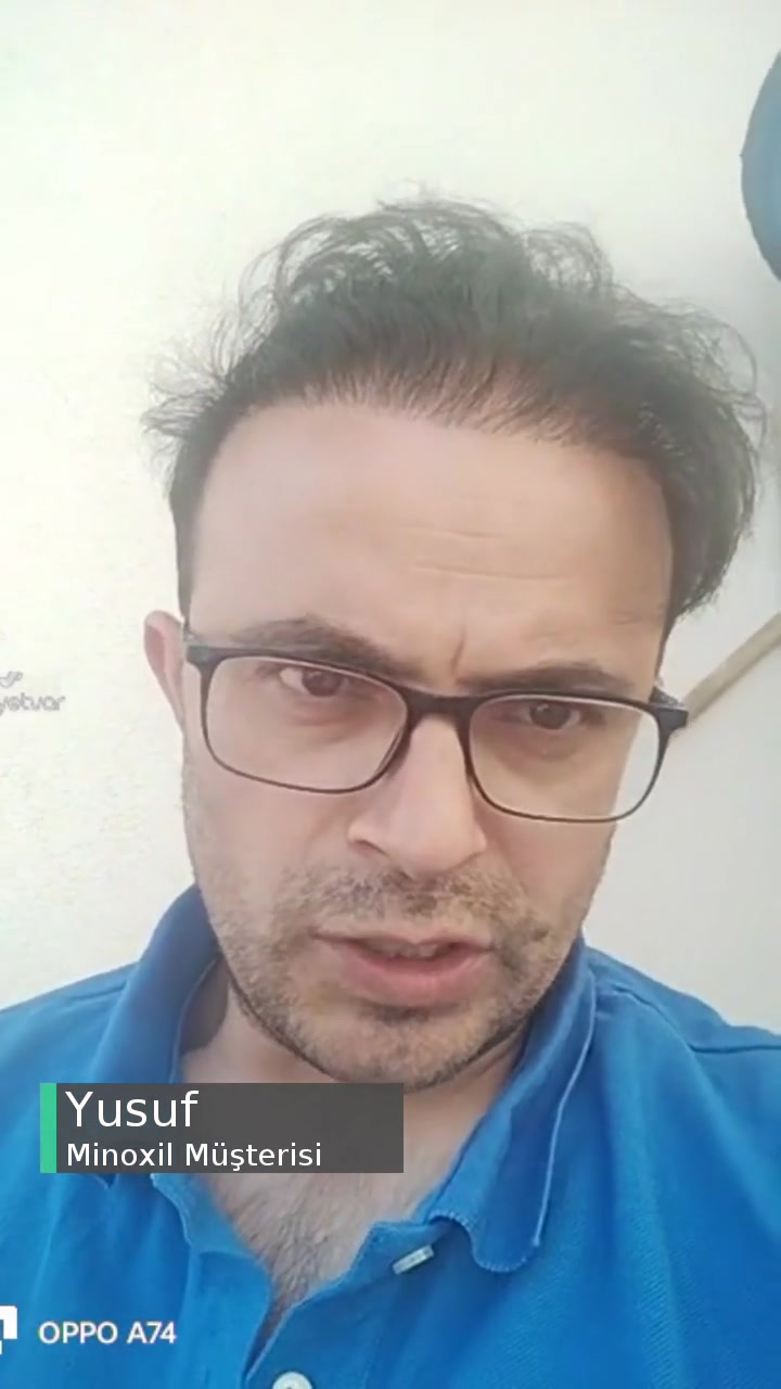 Minoxil İçerik Bilgisi Sıkıntılı! videonun kapak resmi