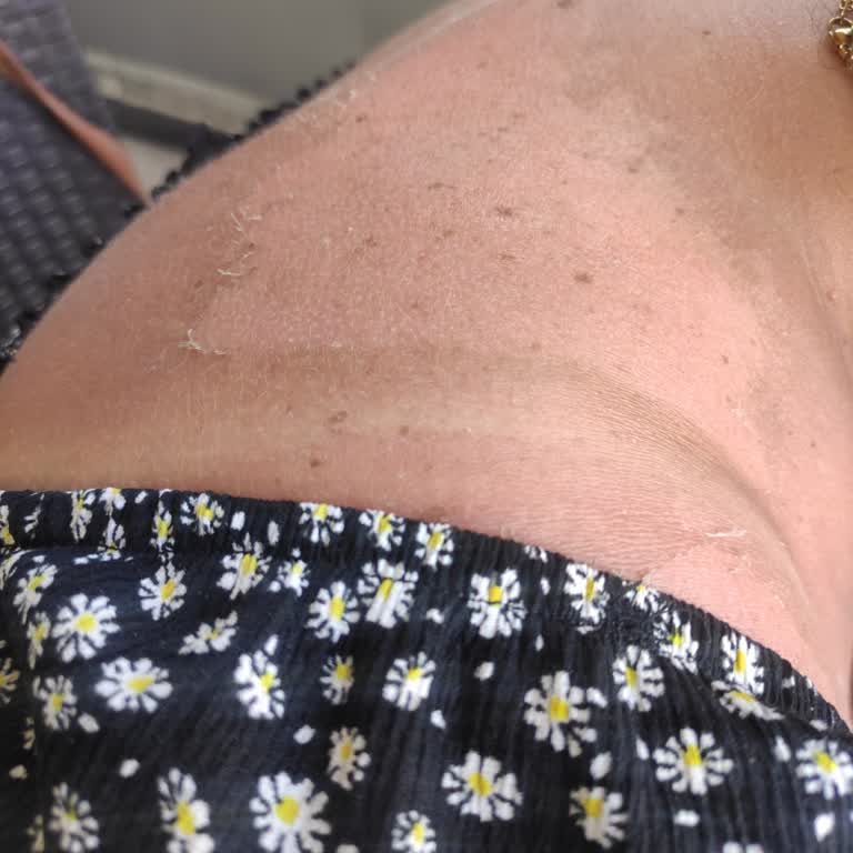 Güneş Kremi Kullanımı Sonrası Ciltte Yanık Oluşması