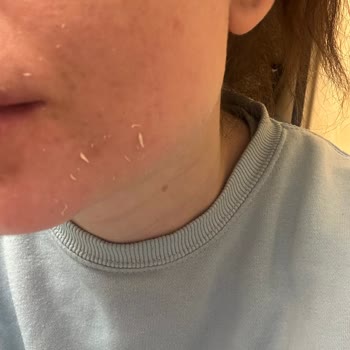 I Used La Roche-Posay Mela B3 Serum But It Peeled Off Like Eraser Bits on My Skin