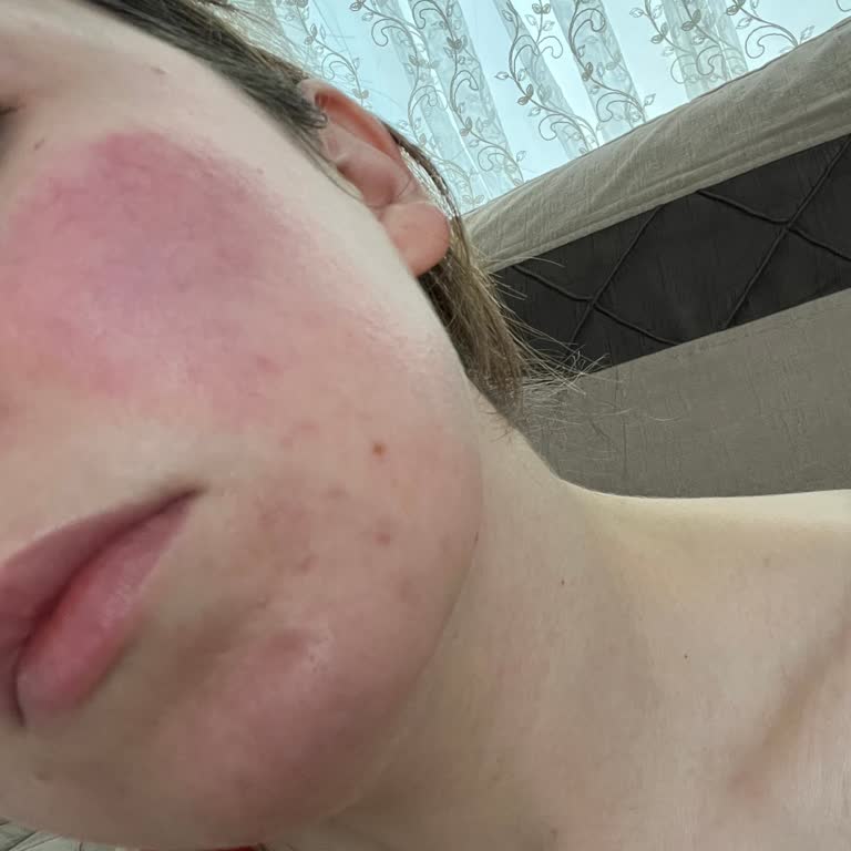 I Bought La Roche-Posay and It Damaged My Skin