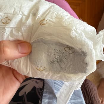 Bebek Bezinde Sakıza Benzer Yabancı Madde Şoku!