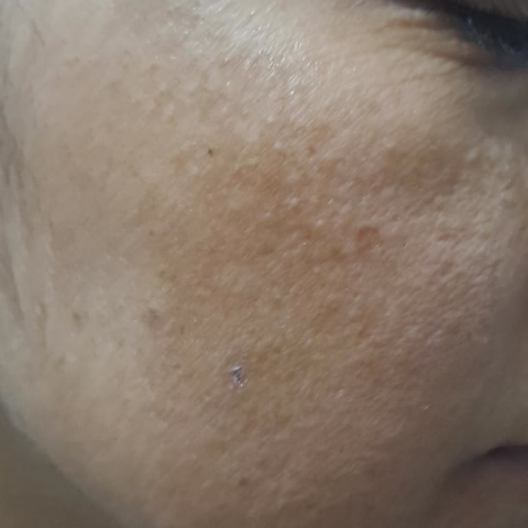 Leke Tedavisi Sonrası Memnuniyetsizlik ve İade Talebi