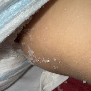 Molfix Bebek Bezinden Kristal Parçalar Dökülmesi Endişesi