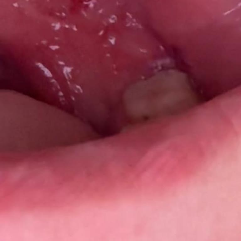 Kanal Tedavisi Sonrası Dişim Sürekli Ağrıyor, İlgisizlik Ve Kötü Deneyim