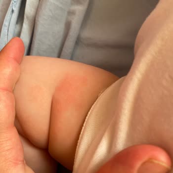 Mustela Şampuan Çocuğumda Cilt Sorunlarına Yol Açtı