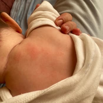 Mustela Şampuan Çocuğumda Cilt Sorunlarına Yol Açtı