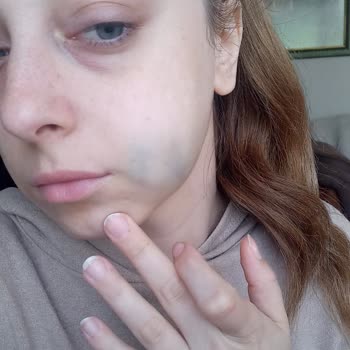 Röntgensiz Tedavi Sonrası Yüzümde Morarma Ve Şişlik Oluştu