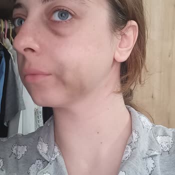 Röntgensiz Tedavi Sonrası Yüzümde Morarma Ve Şişlik Oluştu