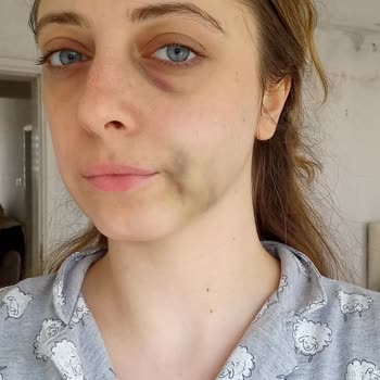 Röntgensiz Tedavi Sonrası Yüzümde Morarma Ve Şişlik Oluştu