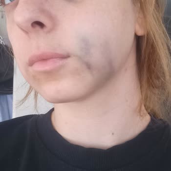 Röntgensiz Tedavi Sonrası Yüzümde Morarma Ve Şişlik Oluştu