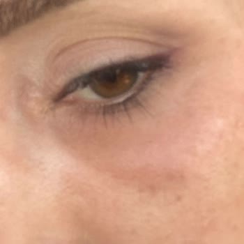 Yves Rocher Göz Altı Ürünü Cildimde Alerjik Reaksiyona Neden Oldu