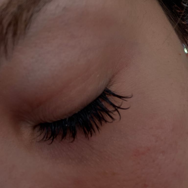 Üst Göz Kapağı Dolgusu Sonrası Memnuniyetsizlik