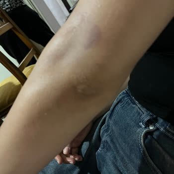 Nişantaşı Vip Güzellik Lazerde Kolumu ve Bacağımı Yaktılar