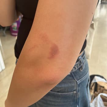 Nişantaşı Vip Güzellik Lazerde Kolumu ve Bacağımı Yaktılar