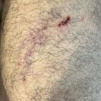 Parkta Saldırgan Köpek Nedeniyle Yaşanan Yaralanma Ve Belediyeden Geri Dönüş Alamama