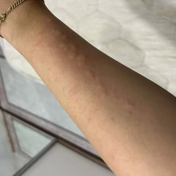 Philips Lumea Cihazı Cildimde Yanma Ve Kabarcık Oluşturdu