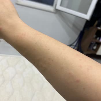 Philips Lumea Cihazı Cildimde Yanma Ve Kabarcık Oluşturdu