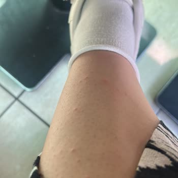 Philips Lumea Cihazı Cildimde Yanma Ve Kabarcık Oluşturdu