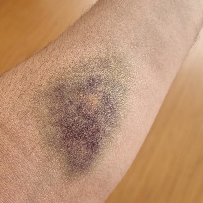 Serum Sonrası Kolumda Şişlik Ve Morarma Yaşadım