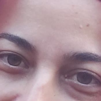 Dr. Salih Aygül Kliniği Gözümdeki Morluk Geçmedi