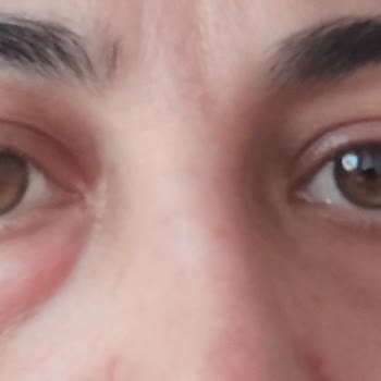 Dr. Salih Aygül Kliniği Gözümdeki Morluk Geçmedi