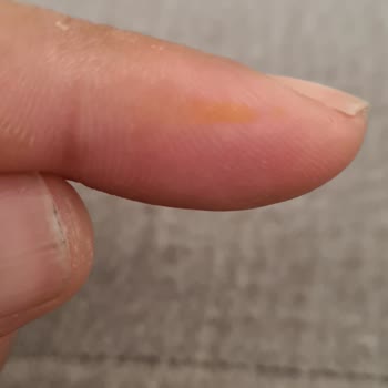 Test Kiti Kullanımı Sonrası Sağlık Sorunları Ve Yetersiz Bilgilendirme