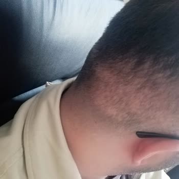 Kadir Sezik Saç Ekim Merkezi Kök Alınan Bölgede Ciddi Seyrelme Ve İz Oluştu!