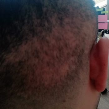 Kadir Sezik Saç Ekim Merkezi Kök Alınan Bölgede Ciddi Seyrelme Ve İz Oluştu!