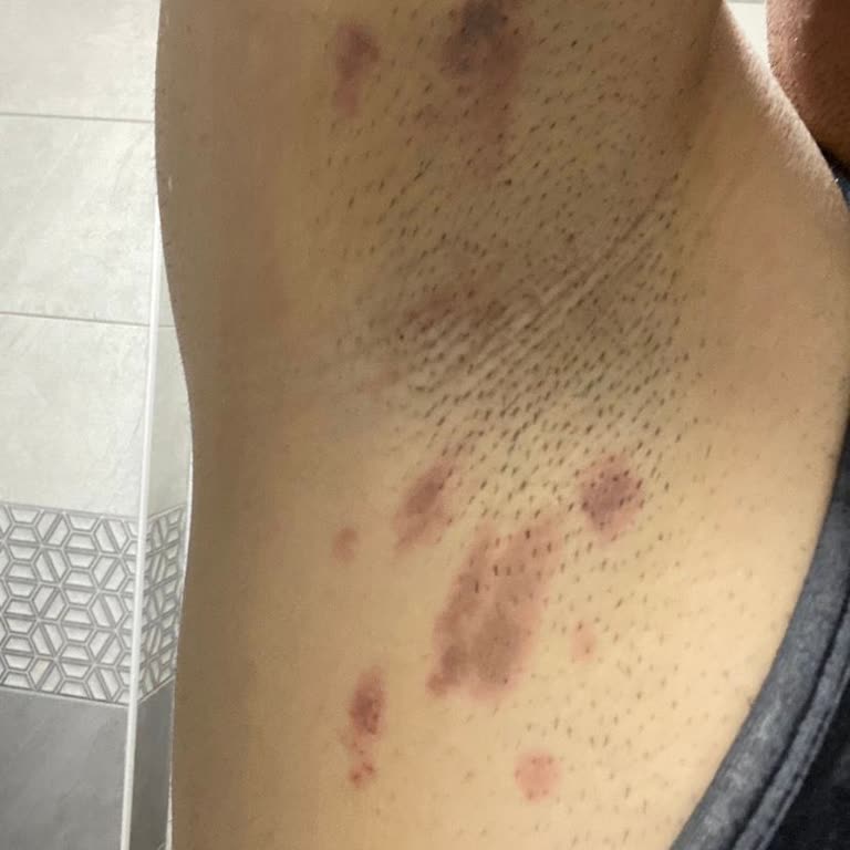 Lazer Epilasyon Sonrası Yanık Ve Etkisizlik Mağduriyeti